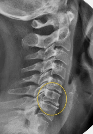 Остеохондроза на шийния гръбначен стълб върху x -ray